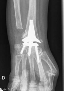 Prótese Total do punho no Hospital da Parede, Cascais 3 ptp