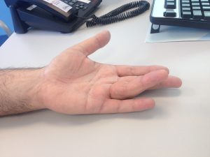 Doença de Dupuytren 2 1