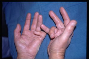 Doença de Dupuytren 3 2