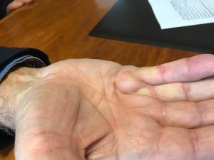 Doença de Dupuytren 8 2a