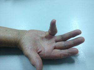 Doença de Dupuytren 9 2b