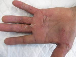 Doença de Dupuytren 7 6