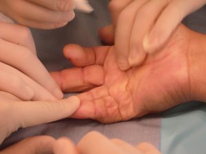 Doença de Dupuytren 10 7