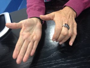 Doença de Dupuytren 11 8 knucle pads