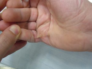 Doença de Dupuytren 17 DSC06272