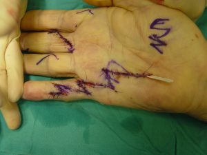 Doença de Dupuytren 18 DSC06273