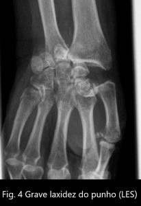 Fig 4 – Grave laxidez do punho com translação cubital do carpo