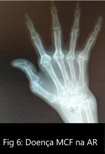Fig 6 doença MCF na AR.jpg