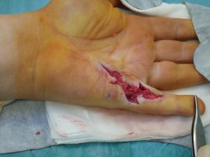 Doença de Dupuytren 13 SDC10754