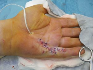 Doença de Dupuytren 14 SDC10757