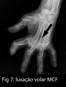 fig 7 luxação volar MCF