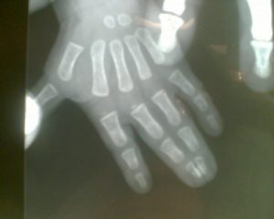 Sindactilias 3 Fig. 2