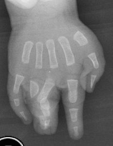 Sindactilias 4 Fig. 3