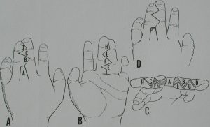 Sindactilias 6 Sin 5