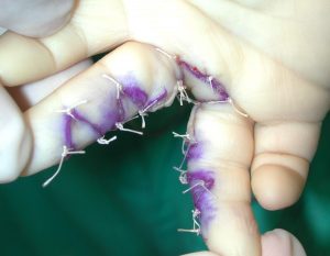 Sindactilias 7 Sin 6