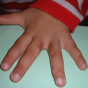 Sindactilias 8 Sin 7