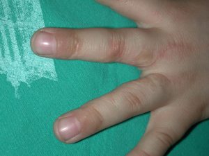 Sindactilias 9 Sin 8