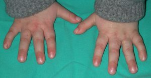 Sindactilias 10 Sin 9