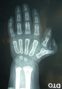 Polidactilias 2 Fig. 1