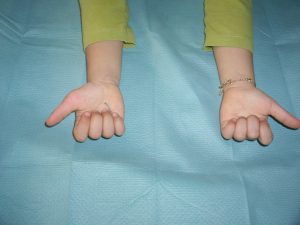 Polidactilias 11 Fig. 10