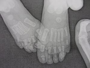 Polidactilias 12 Fig. 11