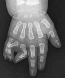 Polidactilias 3 Fig. 2