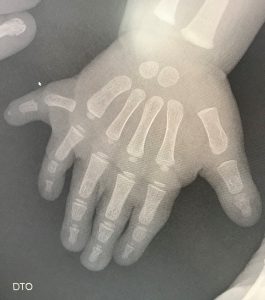 Polidactilias 4 Fig. 3