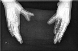 Polidactilias 5 Fig. 4