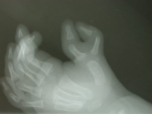 Polidactilias 6 Fig. 5