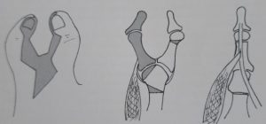 Polidactilias 7 Fig. 6a