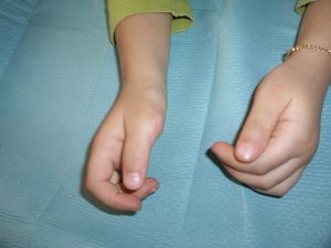 Polidactilias 9 Fig. 8