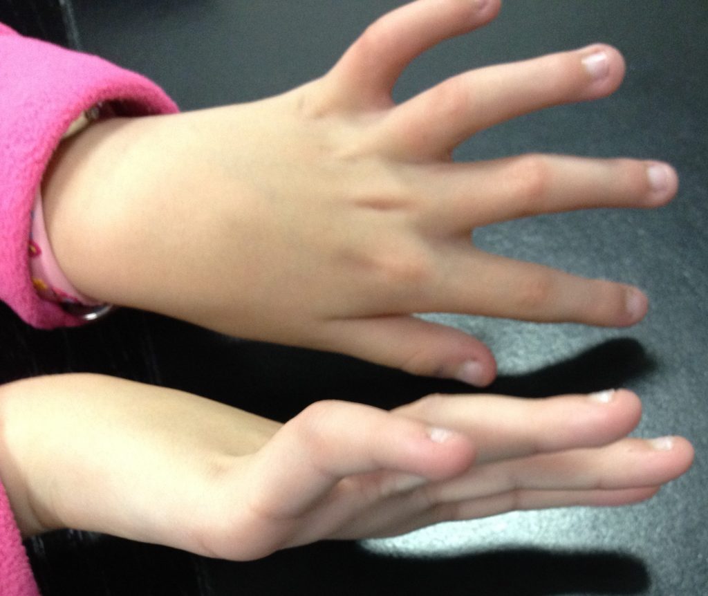 CAMPTODACTILIA 2 Fig. 1