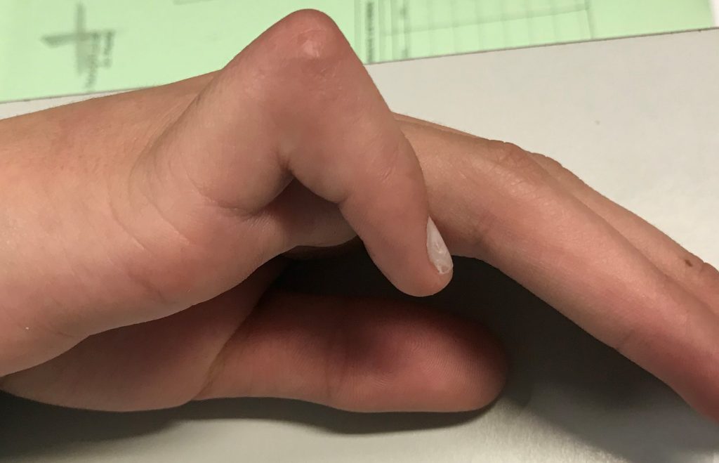 CAMPTODACTILIA 3 Fig. 2