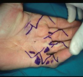 1.1 planeamento pre op