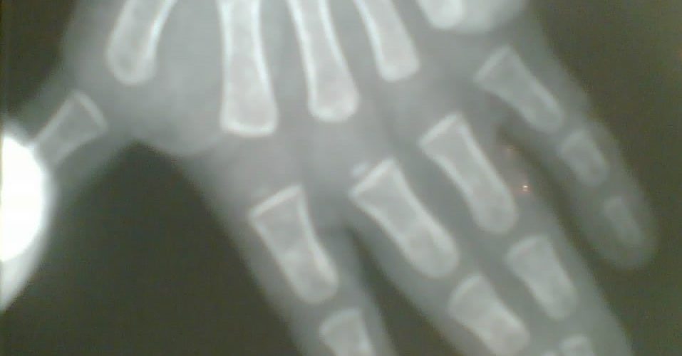 Sindactilias 1 sin10