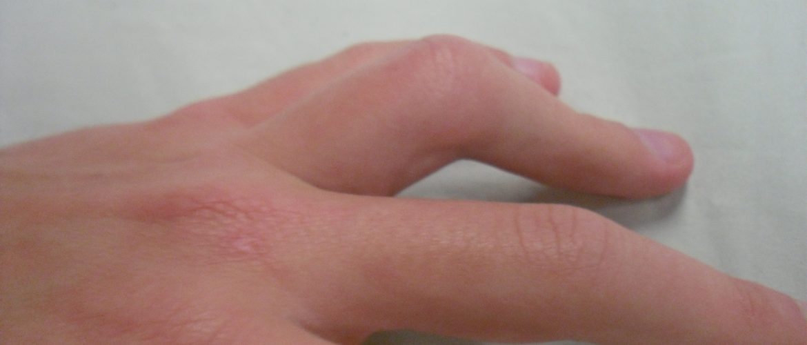 CAMPTODACTILIA 1 1 1