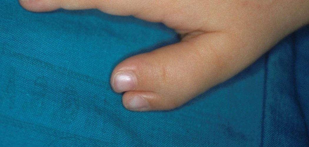 Polidactilias 1 405 97 2