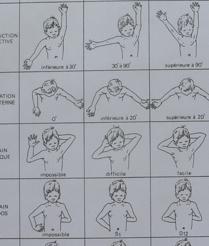 A Paralisia Obstétrica do Plexo Braquial no Congresso SPOT 2017 1 2.1