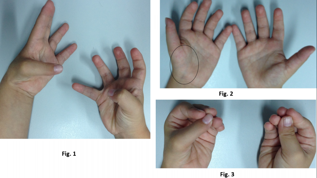 Hipoplasias do polegar 1 1 2 3