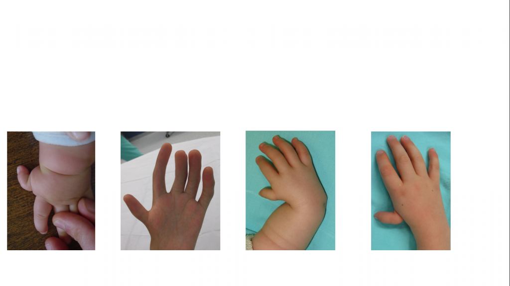 Hipoplasias do polegar 4 10 11 12 13