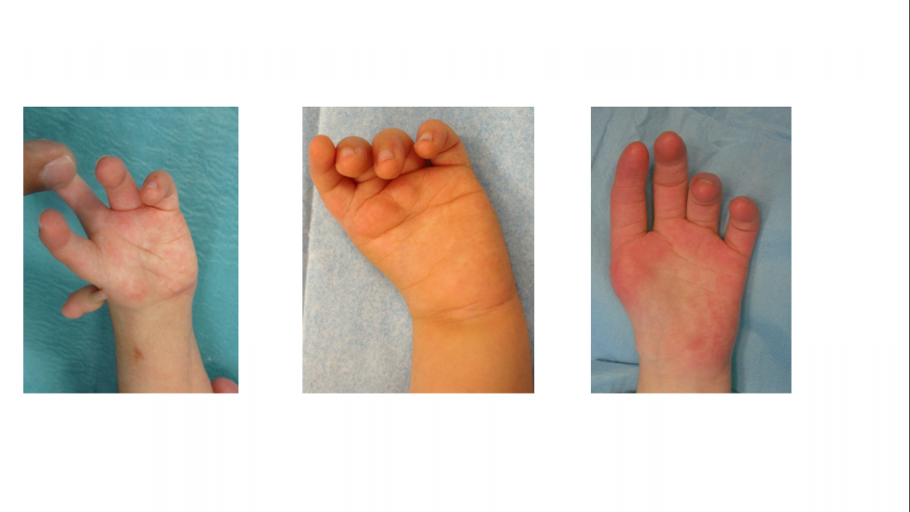 Hipoplasias do polegar 5 14 15 16