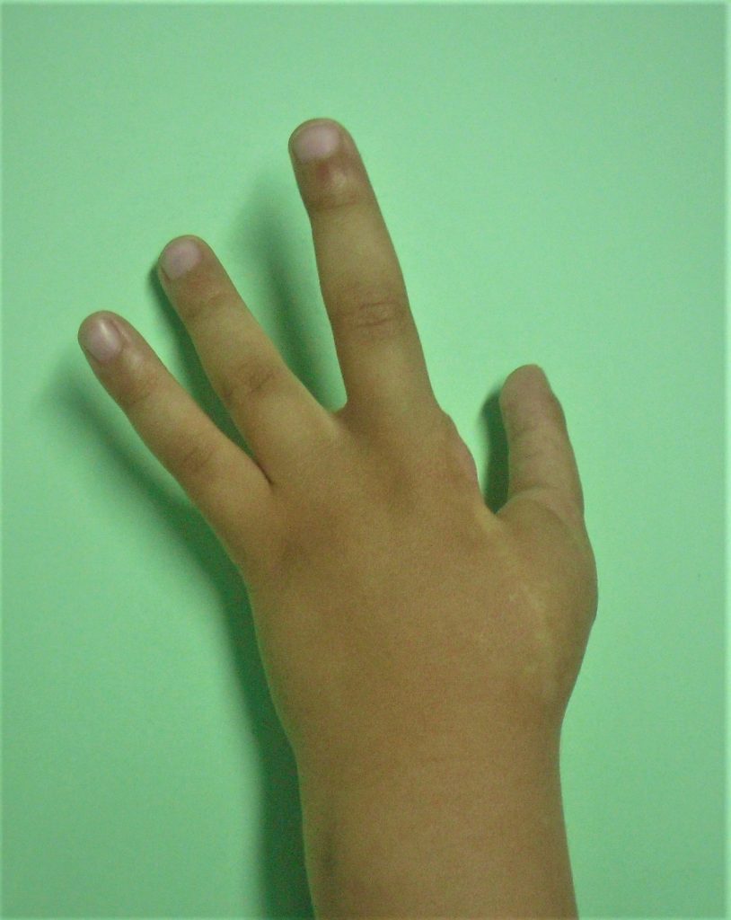 Hipoplasias do polegar 6 17