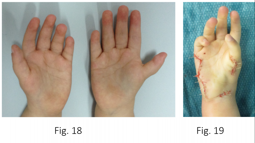 Hipoplasias do polegar 7 18 19