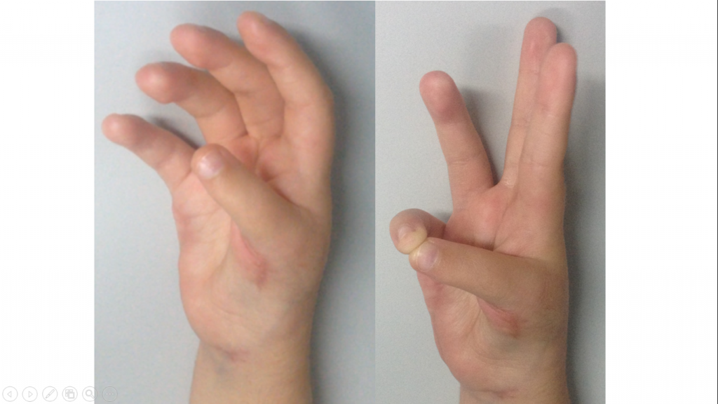 Hipoplasias do polegar 8 20