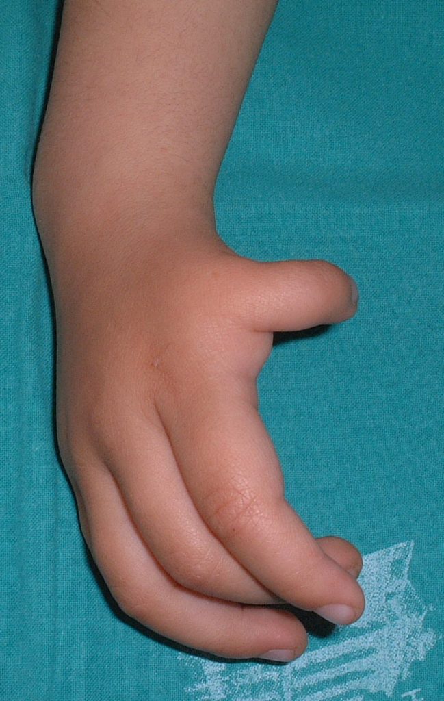 Hipoplasias do polegar 9 21