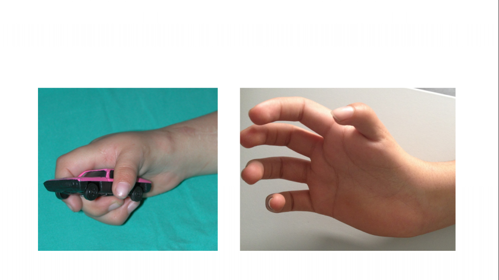 Hipoplasias do polegar 10 22 23