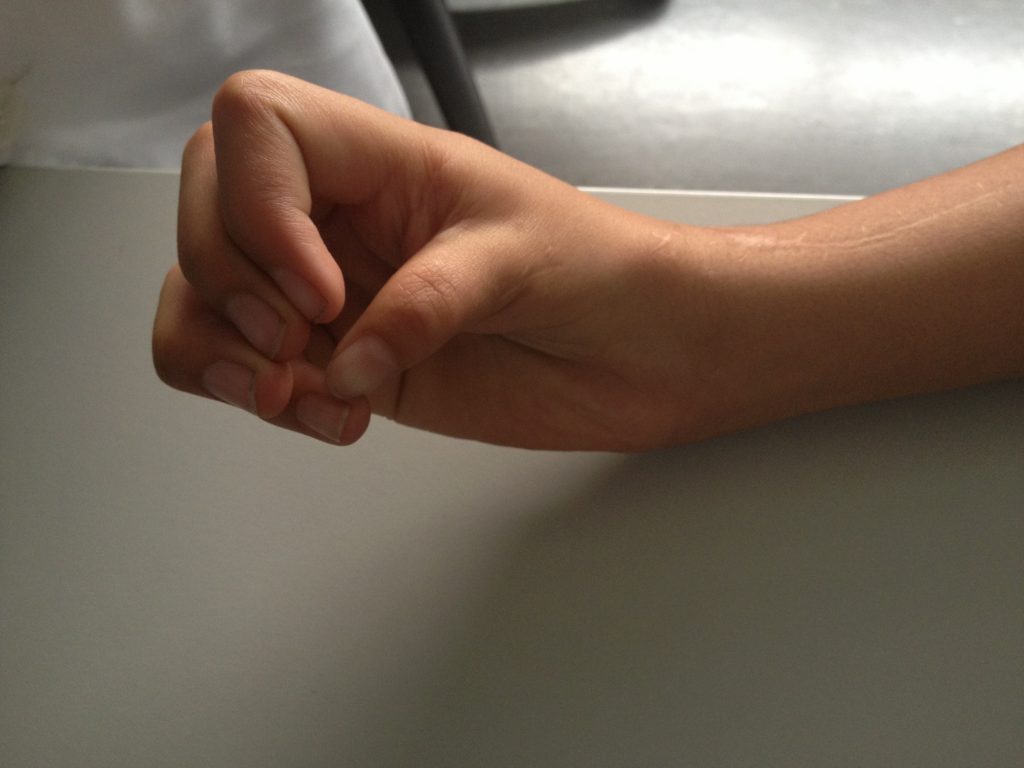 Hipoplasias do polegar 11 24