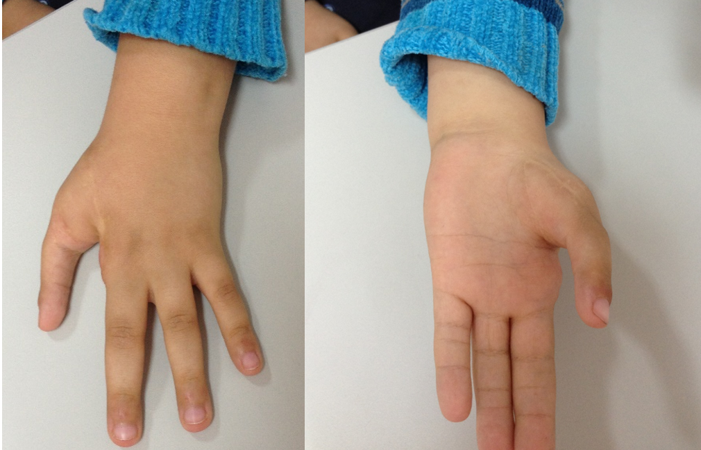 Hipoplasias do polegar 12 25