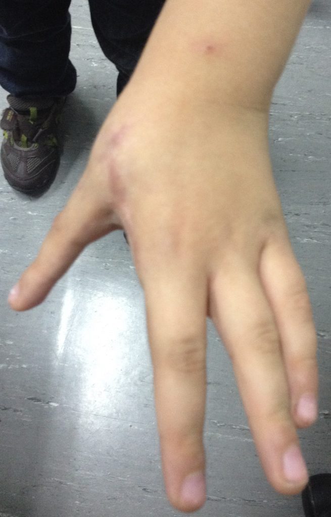 Hipoplasias do polegar 13 26