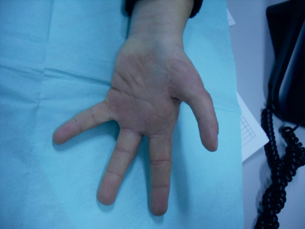 Hipoplasias do polegar 14 27